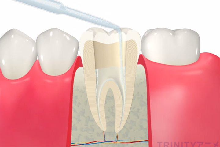 根管治療の流れ3