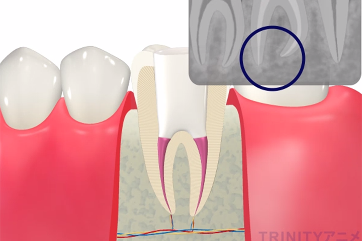 根管治療の流れ4