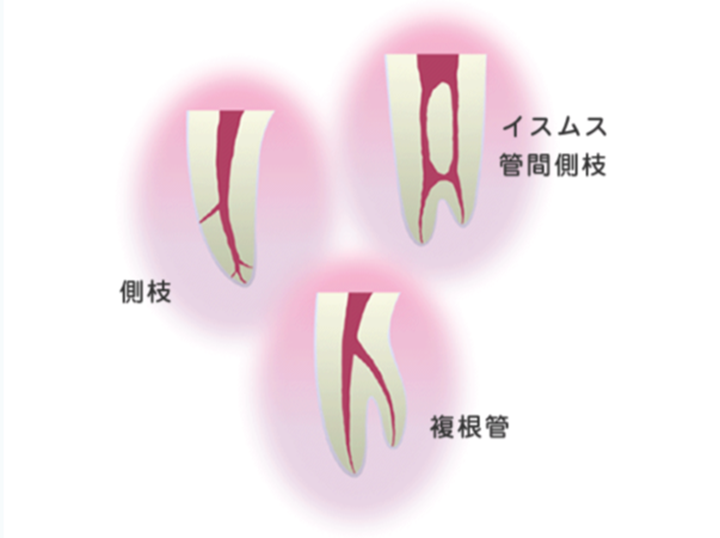 非常に複雑な根管の形態